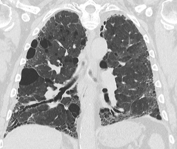 Combined pulmonary fibrosis and emphysema. Coronal CT image demonstrates upper lung–predominant centrilobular and paraseptal emphysema with additional lower lung, peripheral-predominant reticular abnormality, traction bronchiectasis, and honeycomb cyst formation.