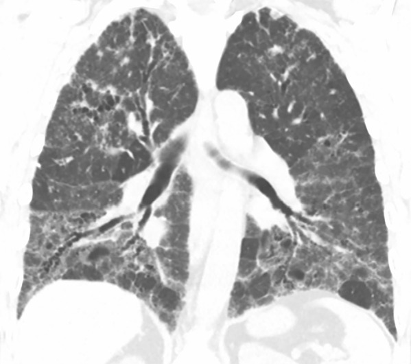 CT-histologic correlation in fibrotic hypersensitivity pneumonitis (HP). (a) Coronal CT image shows lower lung–predominant reticular and ground-glass abnormality. The findings of mosaic attenuation and peribronchovascular predominance are highly suggestive of fibrotic HP. (b) Photomicrograph from histologic examination shows centrilobular scarring compatible with fibrotic HP. (Hematoxylin-eosin stain) (c) Peribronchiolar poorly formed nonnecrotizing granulomas are also present, highly suggestive of HP. (Hematoxylin-eosin stain) (Histologic images courtesy of Rosane Duarte Achcar, MD, National Jewish Health.)