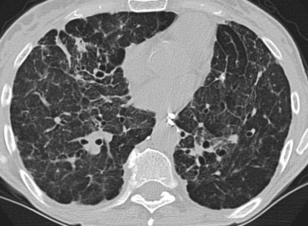 Advanced fibrotic sarcoidosis. (a–c) Axial inspiratory CT and (d) coronal inspiratory CT images demonstrate mid to upper lung–predominant pulmonary fibrosis with marked architectural distortion, associated lung nodularity, and some mosaic attenuation. Note also the calcified mediastinal lymph nodes. This case would be categorized as most consistent with a nonidiopathic pulmonary fibrosis diagnosis based on these features.