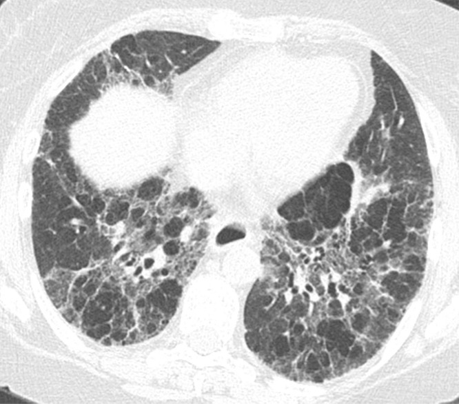 Fibrotic hypersensitivity pneumonitis. (a–c) Axial inspiratory CT scans demonstrate substantial ground-glass abnormality, mild centrilobular nodularity, and moderate mosaic attenuation, in addition to peribronchovascular and lower lung–predominant fibrosis. (d–f) Axial expiratory CT images confirm air trapping as the cause of mosaic attenuation. The degree of ground-glass abnormality, the degree of air trapping, and the peribronchovascular predominance of fibrosis would result in this case being categorized as most consistent with a nonidiopathic pulmonary fibrosis diagnosis.