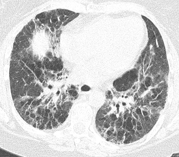 Fibrotic hypersensitivity pneumonitis. (a–c) Axial inspiratory CT scans demonstrate substantial ground-glass abnormality, mild centrilobular nodularity, and moderate mosaic attenuation, in addition to peribronchovascular and lower lung–predominant fibrosis. (d–f) Axial expiratory CT images confirm air trapping as the cause of mosaic attenuation. The degree of ground-glass abnormality, the degree of air trapping, and the peribronchovascular predominance of fibrosis would result in this case being categorized as most consistent with a nonidiopathic pulmonary fibrosis diagnosis.