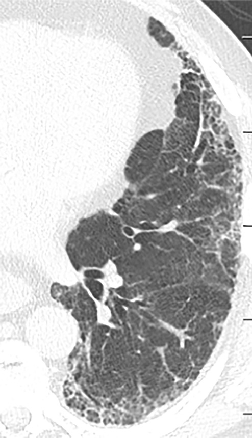 Acute exacerbation of idiopathic pulmonary fibrosis. (a) Zoomed view of axial CT demonstrates a probable usual interstitial pneumonia pattern in a patient with idiopathic pulmonary fibrosis. (b) Zoomed view of axial CT obtained after rapid deterioration in symptoms demonstrates CT findings of acute exacerbation with progression of reticular abnormality and marked new superimposed ground-glass opacity. Other causes of airspace disease including infection were clinically excluded. (c) Zoomed view of axial CT obtained after resolution of acute exacerbation confirms that the background fibrosis has substantially progressed.