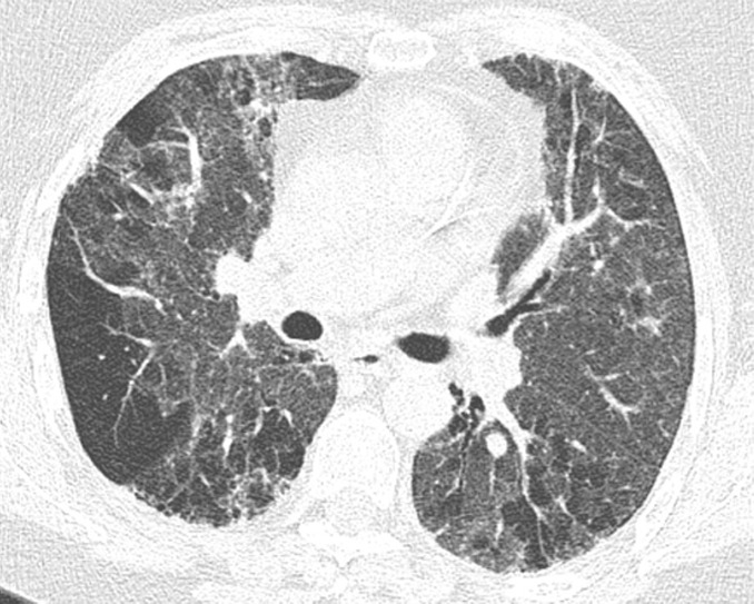 Fibrotic hypersensitivity pneumonitis. (a–c) Axial inspiratory CT scans demonstrate substantial ground-glass abnormality, mild centrilobular nodularity, and moderate mosaic attenuation, in addition to peribronchovascular and lower lung–predominant fibrosis. (d–f) Axial expiratory CT images confirm air trapping as the cause of mosaic attenuation. The degree of ground-glass abnormality, the degree of air trapping, and the peribronchovascular predominance of fibrosis would result in this case being categorized as most consistent with a nonidiopathic pulmonary fibrosis diagnosis.