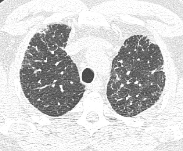 CT pattern indeterminate for usual interstitial pneumonia. (a–c) Axial inspiratory CT images demonstrate peripheral and lower lung–predominant reticular abnormality with architectural distortion, including traction bronchiectasis. However, there is slightly more ground-glass abnormality than typically seen with a confident diagnosis of a usual interstitial pneumonia pattern, and the reticular abnormality extends along the bronchovascular bundles rather than being confined to the subpleural lung.