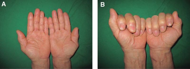 Formation of multiple ganglion cysts along the flexor tendon after open ...