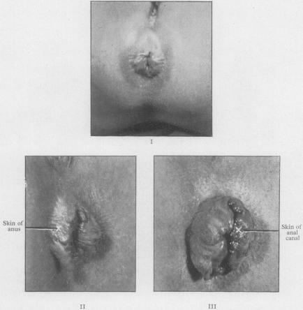 FIG. 12(I, II, III)