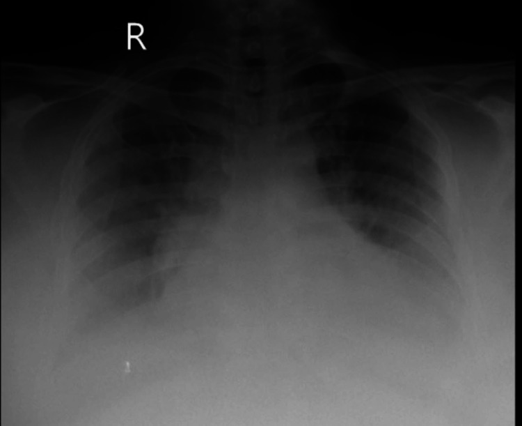 a-clinical-encounter-with-pickwickian-syndrome-pmc