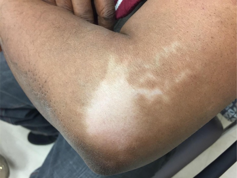 permanent-hypopigmentation-after-triamcinolone-injection-for-tennis