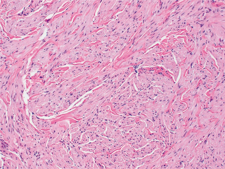 Successful treatment of multiple cutaneous leiomyomas with carbon ...