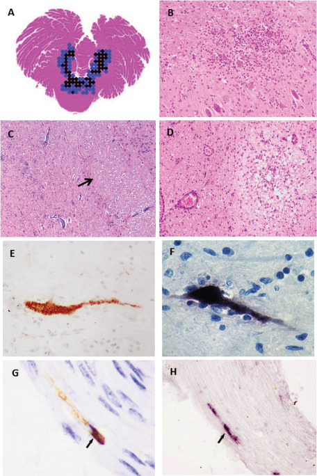 Understanding Enterovirus 71 Neuropathogenesis and Its Impact on Other ...