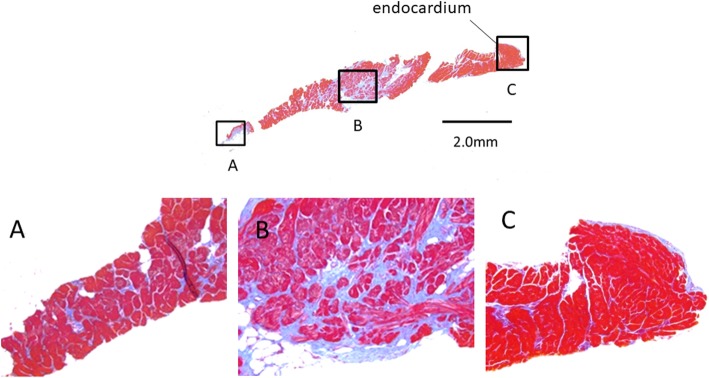 Adult ALCAPA: from histological picture to clinical features - PMC