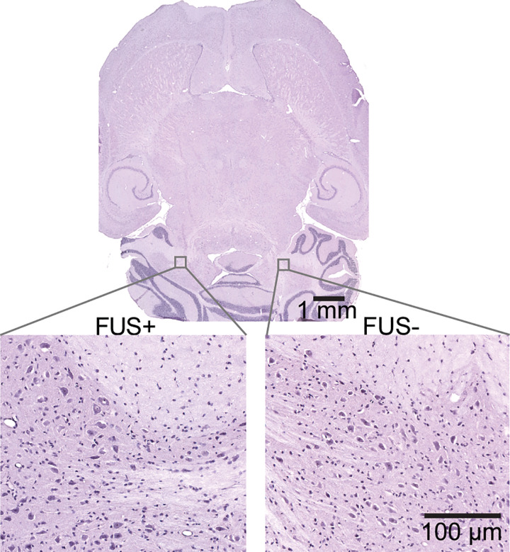 Hemotoxylin-eosin–stained horizontal whole-brain slice (top panel) with higher-magnification images (bottom panels) obtained from the focused ultrasound–treated brain region (FUS+) and contralateral untreated control region (FUS−). No gross tissue damage was observed on the whole-brain slice. Higher-magnification images showed that erythrocyte extravasation and neuronal damage were not observed in either the focused ultrasound–treated brain region or the untreated control brain region.