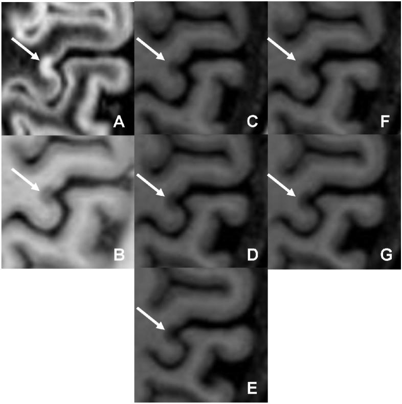 The classification of a lesion as purely intracortical on (a) DIR and (b) PSIR is convincingly confirmed by inclusion of MPRAGE (c □ h)