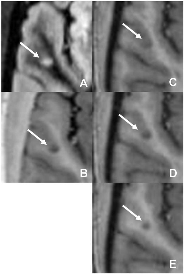 A lesion initially classified as purely intracortical on (a) DIR and (b) PSIR is seen to actually be mixed after inclusion of MPRAGE (c □ e)