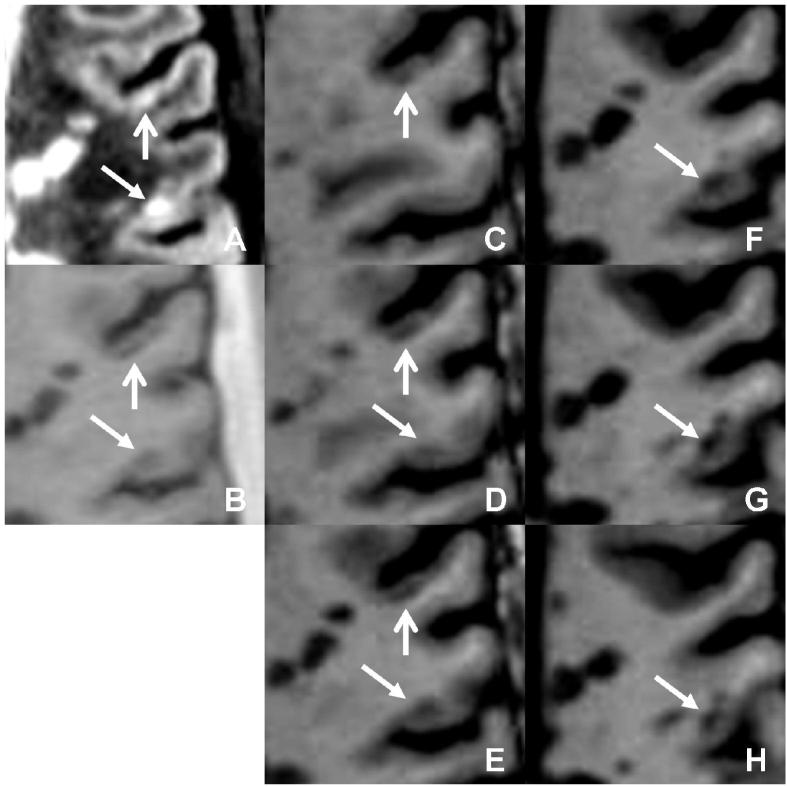 Two intracortical lesions are seen on (a) DIR and (b) PSIR on the same image slice. MPRAGE (c □ h) confirms the classification of the first lesion (vertical arrow) as purely intracortical. However, the classification of the second lesion (oblique arrow) is overturned to juxtacortical