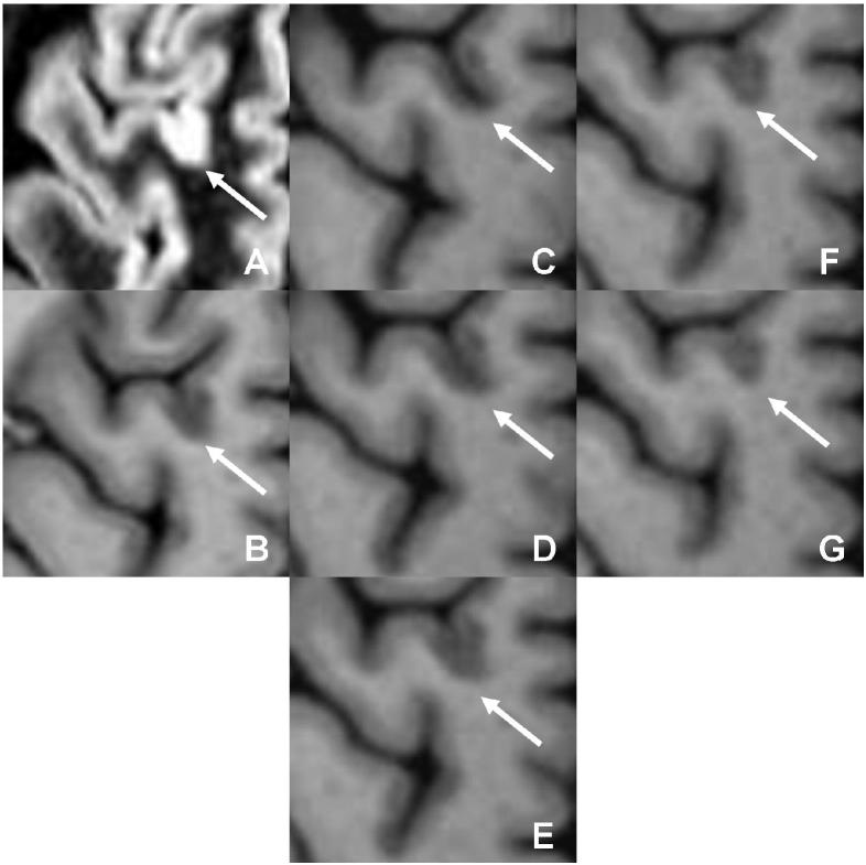 A lesion initially classified as mixed on (a) DIR and (b) PSIR is seen to actually be purely intracortical after inclusion of MPRAGE (c □ g)