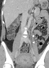 Ovarian vein thrombosis in a 27-year-old woman who presented to the emergency department with right flank pain. Reverse transcription–polymerase chain reaction test results confirmed COVID-19. Coronal contrast-enhanced CT image of the abdomen and pelvis shows a long segment filling defect (arrows) in the left ovarian vein, indicative of gonadal vein thrombosis. Given the positive COVID-19 results, it is uncertain if the viral infection was the cause of the thrombosis, as no other preexisting conditions or risk factors were identified.