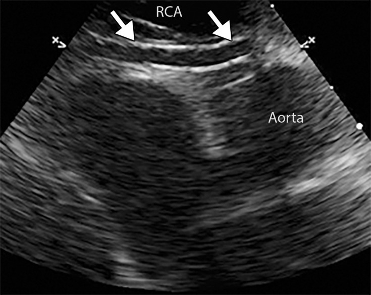 Coronary artery dilatation and decreased ventricular ejection fraction in a 9-year-old boy with a recent history of COVID-19 who presented with new onset of hypotension, kidney disease, and elevated troponin and d-dimer levels (same patient as in Movies 2 and 3). Parasternal short-axis echocardiograms show lack of tapering in the left anterior descending (LAD) coronary artery (arrows in a) and the right coronary artery (RCA) (arrows in b). Left ventricular ejection fraction was decreased (not shown). Ao =aorta, L MCA = left main coronary artery. (Case courtesy of Misra Nilanjana, MD, Northwell Health, New Hyde Park, NY.)