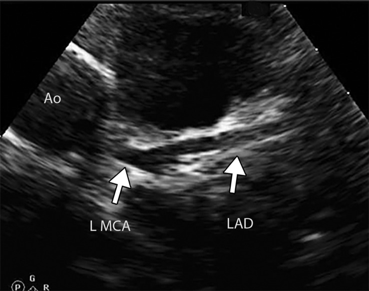 Coronary artery dilatation and decreased ventricular ejection fraction in a 9-year-old boy with a recent history of COVID-19 who presented with new onset of hypotension, kidney disease, and elevated troponin and d-dimer levels (same patient as in Movies 2 and 3). Parasternal short-axis echocardiograms show lack of tapering in the left anterior descending (LAD) coronary artery (arrows in a) and the right coronary artery (RCA) (arrows in b). Left ventricular ejection fraction was decreased (not shown). Ao =aorta, L MCA = left main coronary artery. (Case courtesy of Misra Nilanjana, MD, Northwell Health, New Hyde Park, NY.)