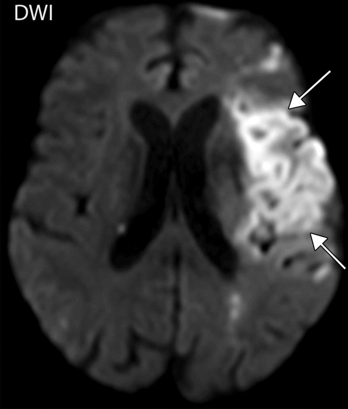 Splenic infarcts and cystitis in an 84-year-old man with a history of newly diagnosed lung cancer who presented to the emergency department with left upper quadrant pain and urinary frequency. The test results confirmed COVID-19. (a, b) Coronal (a) and axial (b) contrast-enhanced CT images of the abdomen and pelvis show multiple wedge-shaped areas of hypoattenuation in the spleen (solid white arrows in a), indicative of multifocal splenic infarcts. Associated thrombosis of one of the splenic hilar branches supplying the anterior upper pole of the spleen is noted (dashed arrow in a). In addition, there is marked irregular wall thickening of the contrast material–filled urinary bladder (B and black arrows in a and b). It is important to note that patients with underlying conditions (such as hypercoagulable state in the setting of malignancy) are prone to develop complications of COVID-19. (c) Axial diffusion-weighted image (DWI) of the brain obtained during a hospital stay for newly developed neurological deficits shows a confluent region of restricted diffusion (arrows) within territory supplied by the left middle cerebral artery, indicative of an acute infarct. A long segment thrombus in the left middle cerebral artery was detected (not shown).