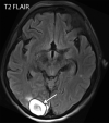 Multiple brain infarcts in various vascular territories and intraparenchymal hemorrhage after extubation in a 58-year-old woman with a history of diabetes mellitus who was hospitalized with COVID-19. The patient’s hospital stay was complicated by multiorgan failure, line sepsis, and new neurologic deficits. (a) Axial T2-weighted (T2) FLAIR brain MR image shows a focal heterogeneous hyperintensity (arrow) within the right occipital lobe, representing an evolving intraparenchymal hematoma, with surrounding edema and mass effect. (b, c) Axial diffusion-weighted (DWI) and ADC MR images show restricted diffusion in the right frontal lobe, compatible with a small focus of acute infarct (arrow). Additional foci of restricted diffusion were depicted in the left frontal lobe (not shown), consistent with small infarcts in different vascular distributions.