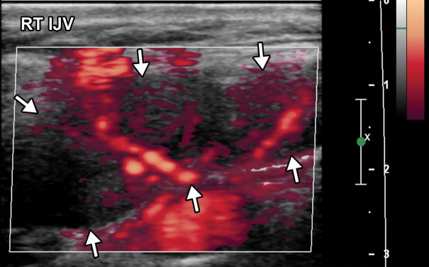 Tonsillitis in a 15-year-old boy who presented to the emergency department with fever, sore throat, malaise, and right neck swelling and was diagnosed with elevated d-dimer levels and inflammatory marker levels. The test results were positive for COVID-19. (a–c) Axial (a) and coronal (b, c) contrast-enhanced neck CT images show enlarged palatine tonsils (black arrows in a and arrows in b). A subtle ill-defined asymmetric area of hypoattenuation is depicted within the enlarged left palatine tonsil, consistent with phlegmon or early abscess (white arrow in a). Associated cervical lymphadenopathy (arrows in c) is depicted. (d) Sagittal power Doppler US image of the right superior neck shows a near-complete occlusive thrombus (arrows) in the right jugular vein (RT IJV).