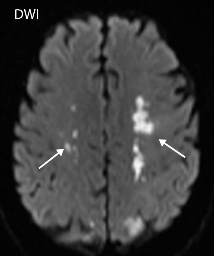 Watershed infarcts and cardioembolic infarcts in a 55-year-old woman with COVID-19 who presented with left gaze deviation. (a) Initial axial T2-weighted (T2) FLAIR brain MR image shows hyperintense signal abnormality (arrows), predominantly within the high frontal and parietal subcortical white matter bilaterally. (b) Repeat axial T2-weighted (T2) FLAIR MR image obtained 3 days later shows interval development of a linearly oriented pattern of signal abnormality (arrows) within the centrum semiovale bilaterally, greater on the left than on the right. (c, d) Axial diffusion-weighted (DWI) (c) and ADC (d) brain MR images show restricted diffusion in the corresponding areas of abnormality (arrows), indicative of watershed infarcts. (e, f) Axial diffusion-weighted (DWI) (e) and ADC (f) brain MR images show restricted diffusion involving the bilateral occipital lobes (arrows), indicative of additional foci of acute infarct.