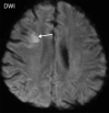 Multiple brain infarcts in various vascular territories and intraparenchymal hemorrhage after extubation in a 58-year-old woman with a history of diabetes mellitus who was hospitalized with COVID-19. The patient’s hospital stay was complicated by multiorgan failure, line sepsis, and new neurologic deficits. (a) Axial T2-weighted (T2) FLAIR brain MR image shows a focal heterogeneous hyperintensity (arrow) within the right occipital lobe, representing an evolving intraparenchymal hematoma, with surrounding edema and mass effect. (b, c) Axial diffusion-weighted (DWI) and ADC MR images show restricted diffusion in the right frontal lobe, compatible with a small focus of acute infarct (arrow). Additional foci of restricted diffusion were depicted in the left frontal lobe (not shown), consistent with small infarcts in different vascular distributions.