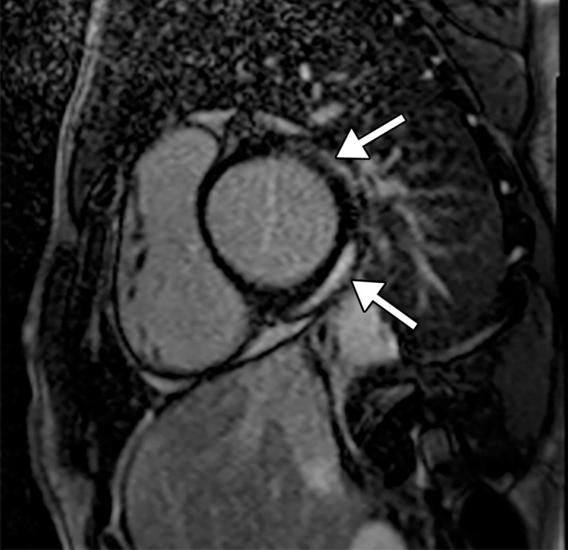 Myocarditis in a 17-year-old adolescent boy who presented to the pediatric emergency room with chest pain and was diagnosed with elevated troponin levels, diffuse ST-segment elevation at electrocardiography, ventricular ectopy, and COVID-19. (a) Cardiac short-axis T2-weighted fat-saturated black-blood MR image shows diffuse increased signal intensity in the subepicardial layer of the septal, lateral, and inferolateral walls in the basal segment (arrows) and subepicardial layer of the lateral and inferolateral walls of the midventricular segments (not shown), consistent with edema. (b) Precontrast T1-weighted short-axis fat-saturated MR image shows normal myocardial thickness and signal intensity (arrows). (c, d) Postcontrast short-axis T1-weighted cardiac MR images obtained at the same level as b show early (c) and delayed (d) subepicardial enhancement of the basal anterior, anterolateral, inferolateral, and inferior segments in a nonischemic pattern (arrows), findings consistent with myocarditis given the clinical context. The enhancement area corresponds to the T2 signal abnormality depicted in a.