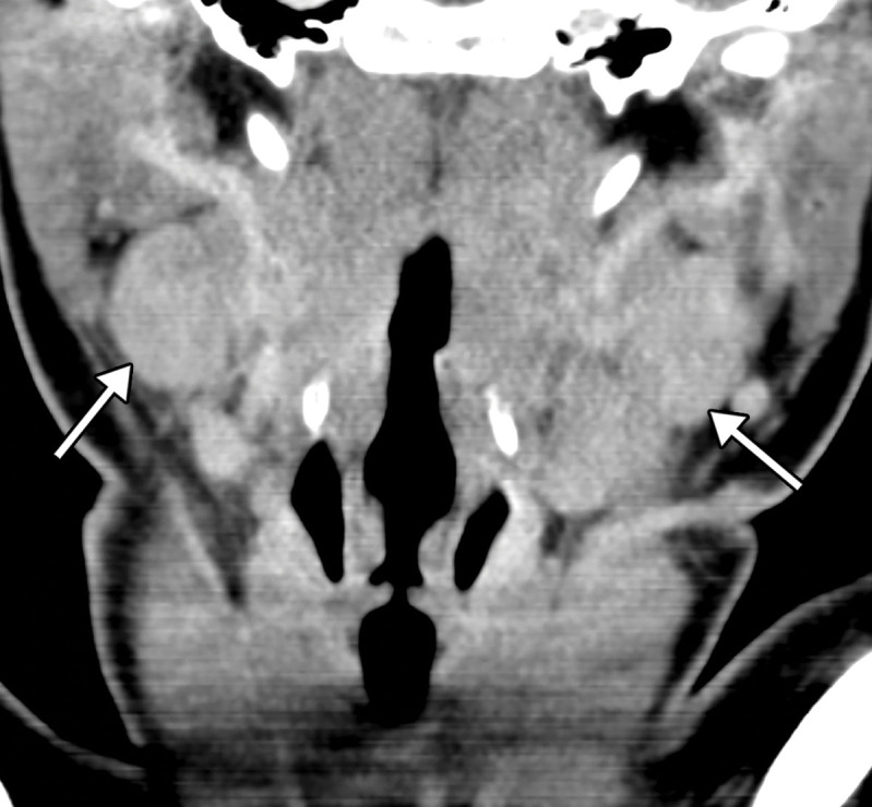 Tonsillitis in a 15-year-old boy who presented to the emergency department with fever, sore throat, malaise, and right neck swelling and was diagnosed with elevated d-dimer levels and inflammatory marker levels. The test results were positive for COVID-19. (a–c) Axial (a) and coronal (b, c) contrast-enhanced neck CT images show enlarged palatine tonsils (black arrows in a and arrows in b). A subtle ill-defined asymmetric area of hypoattenuation is depicted within the enlarged left palatine tonsil, consistent with phlegmon or early abscess (white arrow in a). Associated cervical lymphadenopathy (arrows in c) is depicted. (d) Sagittal power Doppler US image of the right superior neck shows a near-complete occlusive thrombus (arrows) in the right jugular vein (RT IJV).