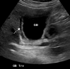 Acute cholecystitis in a critically ill 64-year-old man with COVID-19 and sepsis. Gray-scale (a) and color Doppler (b) US images show a dilated gallbladder (GB) with sludge (* in b). Significant wall edema (dashed arrow) and hyperemia (solid arrows in b) are also present. The US Murphy sign was not assessed owing to the patient’s altered mental status. The findings are indicative of bile stasis and acute cholecystitis. Sterile green thick dark bile was visualized during cholecystostomy placement.