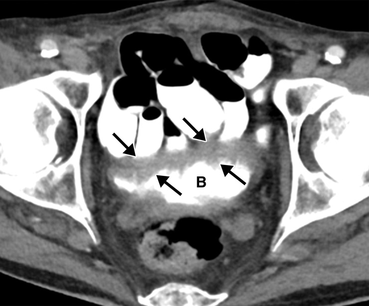 Splenic infarcts and cystitis in an 84-year-old man with a history of newly diagnosed lung cancer who presented to the emergency department with left upper quadrant pain and urinary frequency. The test results confirmed COVID-19. (a, b) Coronal (a) and axial (b) contrast-enhanced CT images of the abdomen and pelvis show multiple wedge-shaped areas of hypoattenuation in the spleen (solid white arrows in a), indicative of multifocal splenic infarcts. Associated thrombosis of one of the splenic hilar branches supplying the anterior upper pole of the spleen is noted (dashed arrow in a). In addition, there is marked irregular wall thickening of the contrast material–filled urinary bladder (B and black arrows in a and b). It is important to note that patients with underlying conditions (such as hypercoagulable state in the setting of malignancy) are prone to develop complications of COVID-19. (c) Axial diffusion-weighted image (DWI) of the brain obtained during a hospital stay for newly developed neurological deficits shows a confluent region of restricted diffusion (arrows) within territory supplied by the left middle cerebral artery, indicative of an acute infarct. A long segment thrombus in the left middle cerebral artery was detected (not shown).