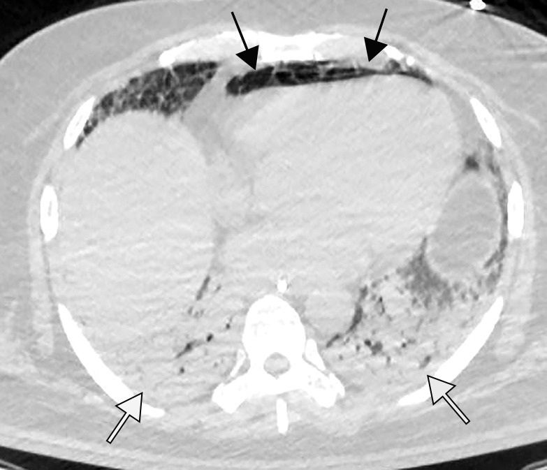 Pneumopericardium with air dissecting into the peritoneum, mimicking bowel perforation, in a 64-year-old man who underwent intubation for COVID-19 pneumonia. (a) Axial nonenhanced chest CT image shows pneumopericardium (black arrows) and bibasilar airspace consolidations (white arrows), compatible with COVID-19 pneumonia. (b) Axial nonenhanced CT image of the abdomen and pelvis shows pneumopericardium and free air under the diaphragm, anterior to the liver (black arrows), without findings of bowel wall ischemia to suggest a perforation (not shown). Note the bibasilar consolidations (white arrows).