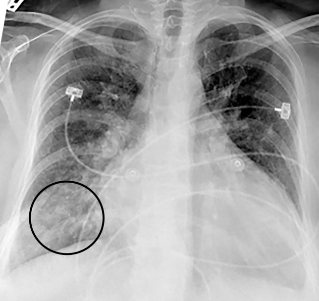 Pulmonary edema in a 50-year-old woman with a history of end-stage renal disease who underwent hemodialysis and who was admitted to the hospital for hypoxia and pneumonia in the setting of COVID-19. (a) Upright posteroranterior chest radiograph obtained at hospital admission shows a right lower lobe consolidation (circle). (b–d) Chest radiograph (b) and axial contrast material–enhanced chest CT images (c, d) obtained after 1 month for persistent hypoxemia show pulmonary edema (with pulmonary venous congestion [black arrows in b] depicted on the chest radiograph), increasing small bilateral pleural effusions (arrows in c), cardiomegaly (arrowheads in b and c), prominent interlobular septal (arrowheads in d) and peribronchovascular (arrow in d) thickening, and diffuse ground-glass opacities. The findings are indicative of pulmonary edema superimposed on the typical appearance of COVID-19 pneumonia. Note that the right lower lobe pneumonia depicted in a is almost completely resolved in b (white arrow in b).