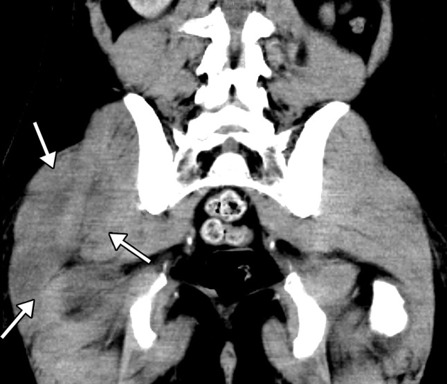 Rhabdomyolysis in a 34-year-old man who presented with minor trauma and was diagnosed with COVID-19 in the emergency department. Laboratory analysis results demonstrated an extremely high creatine kinase level of 35 145 U/L (normal range, 39–308 U/L). (a–c) Coronal (a) and axial (b, c) contrast-enhanced CT images of the pelvis show an enlarged right gluteal region (arrows) without associated fracture. (d–f) Axial (d) and coronal (e) contrast-enhanced chest CT images and a CT image with an artificial intelligence deep learning algorithm for the detection of pulmonary embolism (f) show bilateral multifocal multilobar peribronchovascular patchy airspace and ground-glass opacities (arrows in d), which are a typical finding for COVID-19. Multiple segmental and subsegmental right lower lobe pulmonary emboli (arrows in e and f) were also detected.