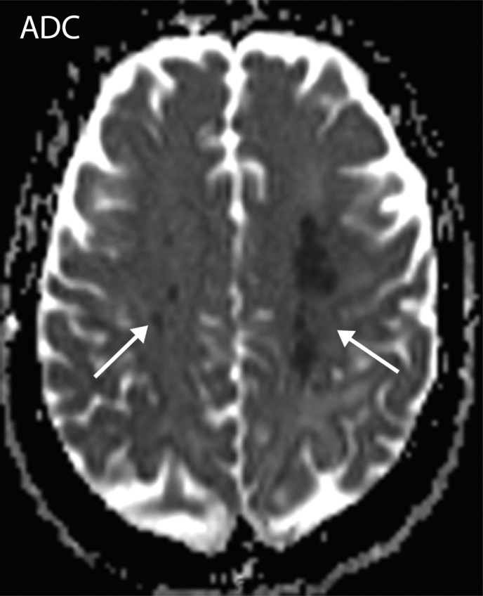 Watershed infarcts and cardioembolic infarcts in a 55-year-old woman with COVID-19 who presented with left gaze deviation. (a) Initial axial T2-weighted (T2) FLAIR brain MR image shows hyperintense signal abnormality (arrows), predominantly within the high frontal and parietal subcortical white matter bilaterally. (b) Repeat axial T2-weighted (T2) FLAIR MR image obtained 3 days later shows interval development of a linearly oriented pattern of signal abnormality (arrows) within the centrum semiovale bilaterally, greater on the left than on the right. (c, d) Axial diffusion-weighted (DWI) (c) and ADC (d) brain MR images show restricted diffusion in the corresponding areas of abnormality (arrows), indicative of watershed infarcts. (e, f) Axial diffusion-weighted (DWI) (e) and ADC (f) brain MR images show restricted diffusion involving the bilateral occipital lobes (arrows), indicative of additional foci of acute infarct.