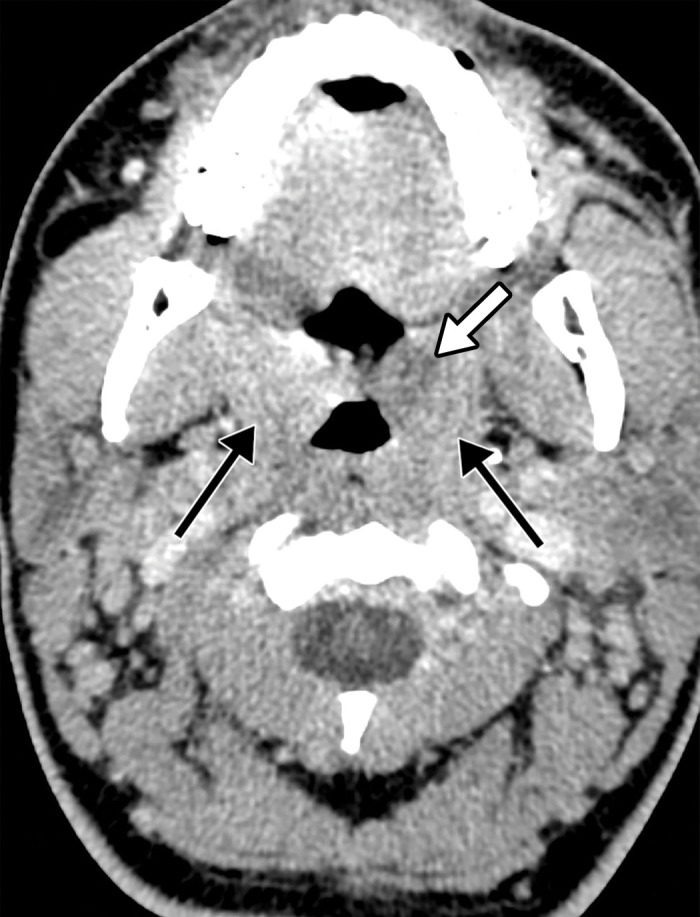 Tonsillitis in a 15-year-old boy who presented to the emergency department with fever, sore throat, malaise, and right neck swelling and was diagnosed with elevated d-dimer levels and inflammatory marker levels. The test results were positive for COVID-19. (a–c) Axial (a) and coronal (b, c) contrast-enhanced neck CT images show enlarged palatine tonsils (black arrows in a and arrows in b). A subtle ill-defined asymmetric area of hypoattenuation is depicted within the enlarged left palatine tonsil, consistent with phlegmon or early abscess (white arrow in a). Associated cervical lymphadenopathy (arrows in c) is depicted. (d) Sagittal power Doppler US image of the right superior neck shows a near-complete occlusive thrombus (arrows) in the right jugular vein (RT IJV).