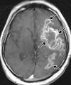 Viral encephalitis in a 57-year-old man with a history of hypoxemic respiratory failure who required intubation in the setting of COVID-19 pneumonia. The hospital stay was complicated by hypercoagulability in the setting of COVID-19. (a, b) Axial (a) and coronal (b) T2-weighted (T2) FLAIR MR images show an infiltrative pattern of heterogeneous signal abnormality (arrows) throughout the left cerebral hemisphere involving the frontal, temporal, and occipital lobes, as well as the basal ganglia and thalamus. (c) Axial susceptibility-weighted image (SWI) shows multiple nodular and curvilinear foci of abnormal magnetic susceptibility (arrows), consistent with foci of parenchymal and subarachnoid hemorrhage. (d) Axial postcontrast T1-weighted MR image shows an amorphous curvilinear pattern of avid contrast enhancement (arrows).