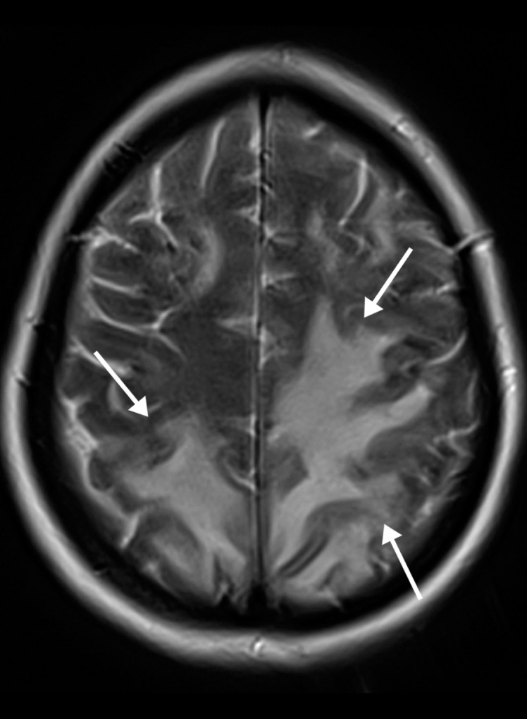 Hemorrhagic diffuse leukoencephalopathy in a 43-year-old woman with COVID-19. The hospital stay was complicated by inability to follow commands and persistently depressed status after extubation. The laboratory test results showed markedly elevated d-dimer levels (>7.6 mg/mL), international normalized ratio level (1.4), and platelet count (290). (a) Axial T2-weighted MR image shows confluent bilateral signal hyperintensities (arrows) in the white matter of both parietal lobes. No associated diffusion restriction was depicted on diffusion-weighted or ADC images (not shown). (b) Axial gradient-echo MR image shows punctate microhemorrhages (arrow) in the subcortical white matter of the left occipital lobe. Multiple microhemorrhages were scattered throughout the cerebral hemispheres bilaterally and in the splenium of the corpus callosum (not shown).