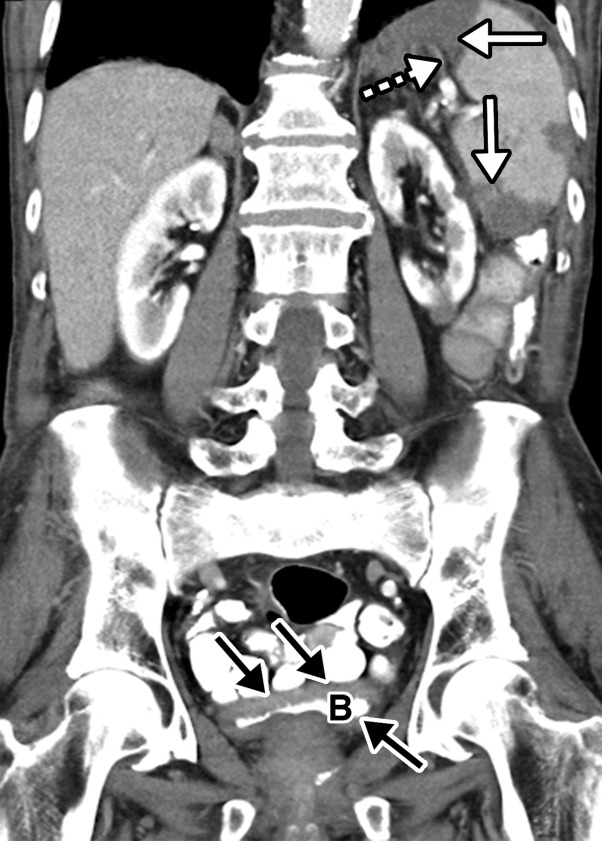 Splenic infarcts and cystitis in an 84-year-old man with a history of newly diagnosed lung cancer who presented to the emergency department with left upper quadrant pain and urinary frequency. The test results confirmed COVID-19. (a, b) Coronal (a) and axial (b) contrast-enhanced CT images of the abdomen and pelvis show multiple wedge-shaped areas of hypoattenuation in the spleen (solid white arrows in a), indicative of multifocal splenic infarcts. Associated thrombosis of one of the splenic hilar branches supplying the anterior upper pole of the spleen is noted (dashed arrow in a). In addition, there is marked irregular wall thickening of the contrast material–filled urinary bladder (B and black arrows in a and b). It is important to note that patients with underlying conditions (such as hypercoagulable state in the setting of malignancy) are prone to develop complications of COVID-19. (c) Axial diffusion-weighted image (DWI) of the brain obtained during a hospital stay for newly developed neurological deficits shows a confluent region of restricted diffusion (arrows) within territory supplied by the left middle cerebral artery, indicative of an acute infarct. A long segment thrombus in the left middle cerebral artery was detected (not shown).