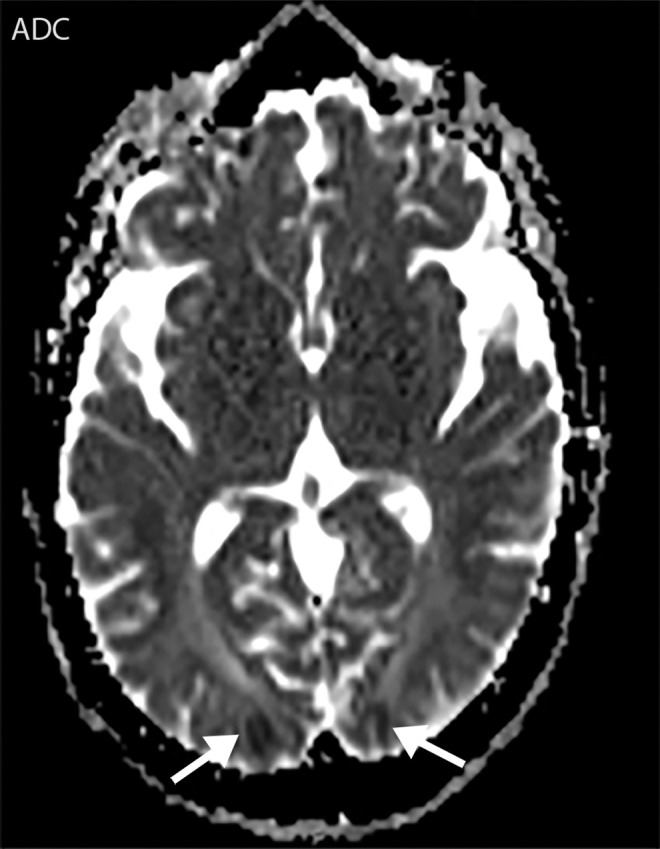 Watershed infarcts and cardioembolic infarcts in a 55-year-old woman with COVID-19 who presented with left gaze deviation. (a) Initial axial T2-weighted (T2) FLAIR brain MR image shows hyperintense signal abnormality (arrows), predominantly within the high frontal and parietal subcortical white matter bilaterally. (b) Repeat axial T2-weighted (T2) FLAIR MR image obtained 3 days later shows interval development of a linearly oriented pattern of signal abnormality (arrows) within the centrum semiovale bilaterally, greater on the left than on the right. (c, d) Axial diffusion-weighted (DWI) (c) and ADC (d) brain MR images show restricted diffusion in the corresponding areas of abnormality (arrows), indicative of watershed infarcts. (e, f) Axial diffusion-weighted (DWI) (e) and ADC (f) brain MR images show restricted diffusion involving the bilateral occipital lobes (arrows), indicative of additional foci of acute infarct.