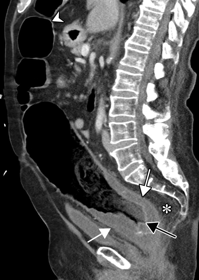 Proctocolitis in a 72-year-old man who presented to the emergency department with abdominal pain and fever and was diagnosed with COVID-19. Sagittal (a) and axial (b) contrast-enhanced CT images of the abdomen and pelvis show marked edema of the distended rectal wall (white arrows), with hyperenhancing mucosa (black arrow) and significant inflammatory changes in the surrounding perirectal fat (*). Note that the remaining large bowel wall is normal (arrowhead in a), and no significant amount of stool is depicted in the rectum. On the day of hospital admission, CT images of the abdomen and pelvis obtained through the lung bases depicted bilateral peripheral airspace opacities, ground-glass opacities, and areas of consolidations (not shown), findings typical of COVID-19 pneumonia.