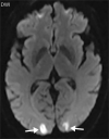 Watershed infarcts and cardioembolic infarcts in a 55-year-old woman with COVID-19 who presented with left gaze deviation. (a) Initial axial T2-weighted (T2) FLAIR brain MR image shows hyperintense signal abnormality (arrows), predominantly within the high frontal and parietal subcortical white matter bilaterally. (b) Repeat axial T2-weighted (T2) FLAIR MR image obtained 3 days later shows interval development of a linearly oriented pattern of signal abnormality (arrows) within the centrum semiovale bilaterally, greater on the left than on the right. (c, d) Axial diffusion-weighted (DWI) (c) and ADC (d) brain MR images show restricted diffusion in the corresponding areas of abnormality (arrows), indicative of watershed infarcts. (e, f) Axial diffusion-weighted (DWI) (e) and ADC (f) brain MR images show restricted diffusion involving the bilateral occipital lobes (arrows), indicative of additional foci of acute infarct.