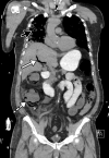 Bowel ischemia and perforation as a complication of COVID-19 in a 65-year-old man with a history of asthma, hypertension, and hyperlipidemia. (a–c) Axial (a, c) and coronal (b, d) intravenous contrast material–enhanced CT images of the abdomen and pelvis show significant pneumatosis of the cecum and right ascending colon (dashed arrows in a and d), with associated perforation of the ascending colon (AC and dashed arrows in b) and a large complex fluid collection with an enhancing rim, indicative of an abscess (solid arrows in b). The abscess is filled with extravasated fecal material. Note the mesenteric venous gas (solid arrows in a), associated with pneumatosis. Note also the small amount of ascites and mesenteric congestion (* in a and d). Portal venous gas is present (solid arrows in c and d). Peripheral airspace disease (black arrow in d) in the right lower lobe is also depicted.