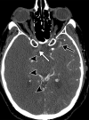 Long segment right internal carotid artery (ICA) occlusion with associated bilateral large middle cerebral artery territory infarcts in a 59-year-old man who underwent intubation due to COVID-19 who presented with sudden onset of confusion. The serum analysis results showed a high d-dimer level of 5.6 mg/mL. (a) Axial nonenhanced head CT image shows large regions of hypoattenuation (arrows) in the bilateral middle cerebral artery territories, reflecting cytotoxic edema secondary to acute bilateral middle cerebral artery territorial infarctions without hemorrhagic transformation. The findings are indicative of cardioembolic phenomena (given various vascular distributions), hypoxic-ischemic injury, or ischemic vasculopathy secondary to COVID-19. (b–d) Sagittal maximum intensity projection (b) and axial head and neck CT angiographic images (c, d) show a long segment filling defect from the proximal cervical segment of the right ICA (arrow in b) to the intracranial ICA, with involvement of the right petrous (not shown) and cavernous ICA segments (arrow in c), indicative of right ICA thrombosis and occlusion. The right carotid terminus (white arrow in d) and right middle cerebral artery are completely occluded, and the M1 segment of the left middle cerebral artery is nearly completely occluded, with only a small sleeve of intravenous contrast material opacifying the artery (black arrow in d). Note that the loss of gray matter–white matter differentiation is more pronounced on the right (arrowheads in d).