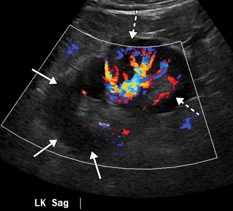 Renal infarct in a critically ill 52-year-old man who underwent intubation for COVID-19 and who presented with oliguria and was diagnosed with elevated creatinine levels. Sagittal color Doppler US image shows a focal area of hypoperfusion (solid arrows) in the upper pole of the left kidney, compatible with an infarct. Normal perfusion (dashed arrows) is seen in the lower pole of the kidney. Bilateral patchy ground-glass opacities, a typical finding of COVID-19 pneumonia, were depicted at chest radiography (not shown).