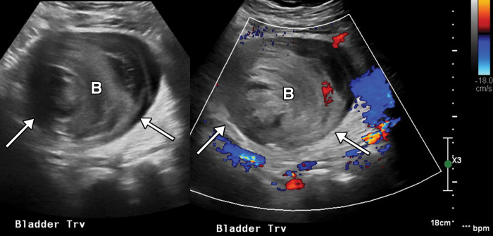 Urinary bladder hemorrhage in an 85-year-old man with COVID-19 pneumonia who developed hematuria and acute renal failure. Transverse gray-scale (left) and color Doppler (right) US images show a distended urinary bladder (B) filled with avascular heterogeneous echogenic material, indicative of urinary bladder hemorrhage (arrows).