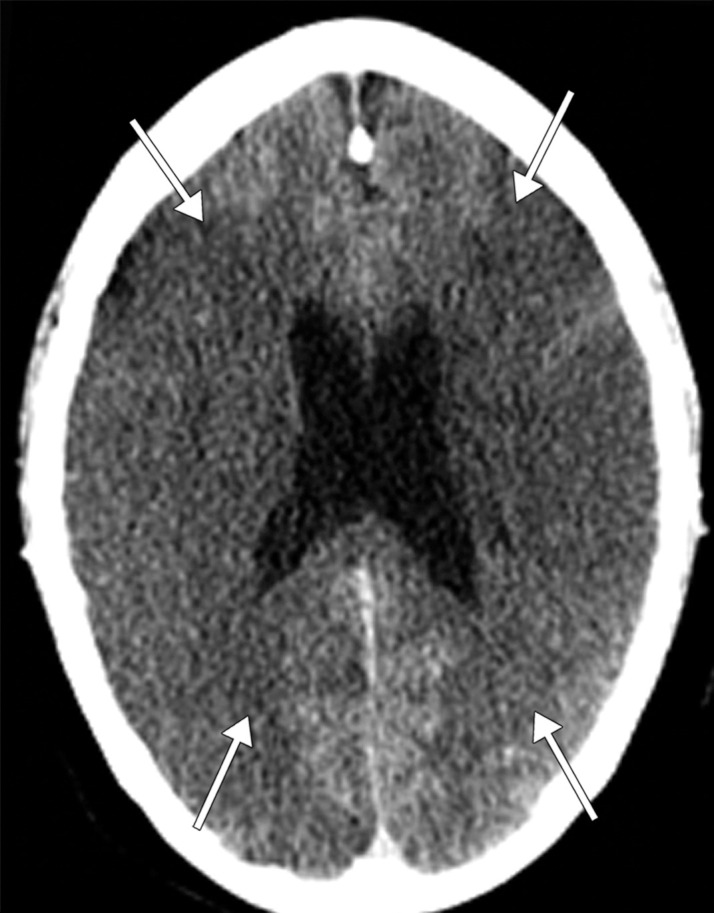 Long segment right internal carotid artery (ICA) occlusion with associated bilateral large middle cerebral artery territory infarcts in a 59-year-old man who underwent intubation due to COVID-19 who presented with sudden onset of confusion. The serum analysis results showed a high d-dimer level of 5.6 mg/mL. (a) Axial nonenhanced head CT image shows large regions of hypoattenuation (arrows) in the bilateral middle cerebral artery territories, reflecting cytotoxic edema secondary to acute bilateral middle cerebral artery territorial infarctions without hemorrhagic transformation. The findings are indicative of cardioembolic phenomena (given various vascular distributions), hypoxic-ischemic injury, or ischemic vasculopathy secondary to COVID-19. (b–d) Sagittal maximum intensity projection (b) and axial head and neck CT angiographic images (c, d) show a long segment filling defect from the proximal cervical segment of the right ICA (arrow in b) to the intracranial ICA, with involvement of the right petrous (not shown) and cavernous ICA segments (arrow in c), indicative of right ICA thrombosis and occlusion. The right carotid terminus (white arrow in d) and right middle cerebral artery are completely occluded, and the M1 segment of the left middle cerebral artery is nearly completely occluded, with only a small sleeve of intravenous contrast material opacifying the artery (black arrow in d). Note that the loss of gray matter–white matter differentiation is more pronounced on the right (arrowheads in d).