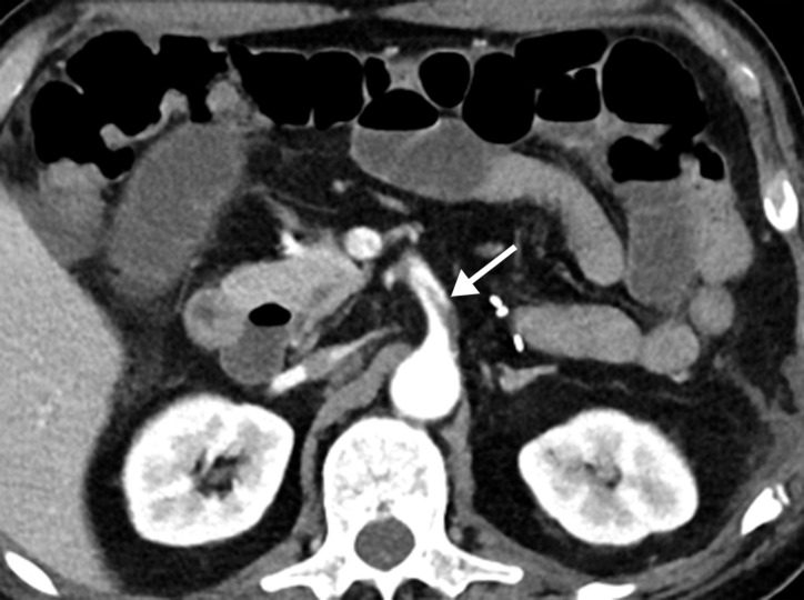 Superior mesenteric artery thrombosis complicated by bowel ischemia and perforation in a 54-year-old man who presented to the emergency department with abdominal pain and was diagnosed with COVID-19. (a–c) Coronal (a) and axial (b, c) contrast-enhanced CT images of the abdomen and pelvis show mucosal hyperenhancement involving the small bowel (F in a, white arrow in c), with associated mild wall thickening. There is a long segment of bowel wall hypoenhancement in the distal ileum, with a large focal wall defect (solid white arrows in a). Note the extension of intraluminal bowel contents, fluid, and air through the defect into the peritoneum (dashed arrow in a). The findings are indicative of bowel ischemia with distal ileal bowel wall perforation. There are multiple fluid-filled dilated loops of small bowel proximal to this region, suggestive of an ileus. There are associated thrombi within the proximal superior mesenteric artery (black arrow in a, arrow in b) and in the distal ileal branches (not shown). Mesenteric congestion and trace ascites are noted (* in a and c). However, no organized fluid collection is depicted. Note the enlarged nonenhancing left external iliac vein, compatible with deep vein thrombosis (black arrow in c). (d) Gray-scale (left) and power Doppler (right) US images of the left upper extremity, obtained owing to arm swelling, show a near-occlusive thrombus extending from the forearm to the upper humeral segment of the cephalic vein (Ceph V) (arrows in d).