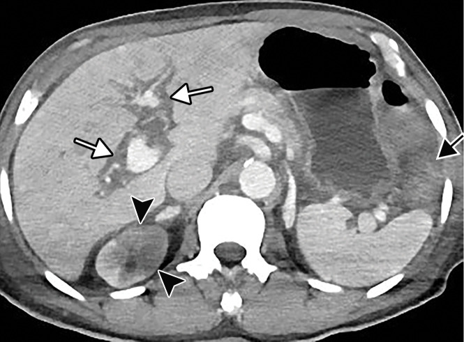 Ischemic enterocolitis, periportal edema, mesenteric congestion, ascites, and multifocal bilateral native and renal transplant infarcts in a severely ill 75-year-old man with COVID-19 pneumonia, elevated liver function test results, and oliguria. (a, b) Coronal (a) and axial (b) contrast-enhanced images of the abdomen and pelvis show marked pericholecystic and periportal edema (white arrows) and thickened small and large bowel (black arrows). Note that the colon is fluid filled. Multifocal wedge-shaped areas of hypoattenuation are depicted in the renal cortex of the transplant kidney allograft and native kidneys (arrowheads), compatible with multifocal native renal and renal transplant infarcts. Note the marked heterogeneity of the liver parenchyma that could be attributable to hepatitis (* in a). The main mesenteric vasculature was patent. Mesenteric congestion and ascites were also present, implying the manifestation of mesenteric ischemia, likely as a result of microthrombosis. (c) Endoscopic image of the left colon shows denudation of the colonic epithelium, compatible with ischemic colitis. (Case courtesy of Christine [Cooky] Menias, MD, Mayo Clinic, Phoenix, Ariz.)